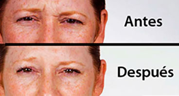 Antes y despues Tratamientos con Toxina Botulínica Tipo A