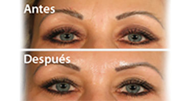 Antes y despues Tratamientos con Toxina Botulínica Tipo A