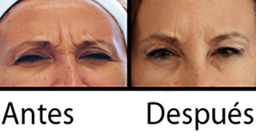 Antes y despues Tratamientos con Toxina Botulínica Tipo A