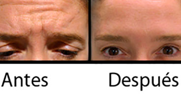 Antes y despues Tratamientos con Toxina Botulínica Tipo A