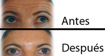 Antes y despues Tratamientos con Toxina Botulínica Tipo A
