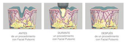 Ilustración antes, durante y después de un procedimiento con Facial Pulsonic